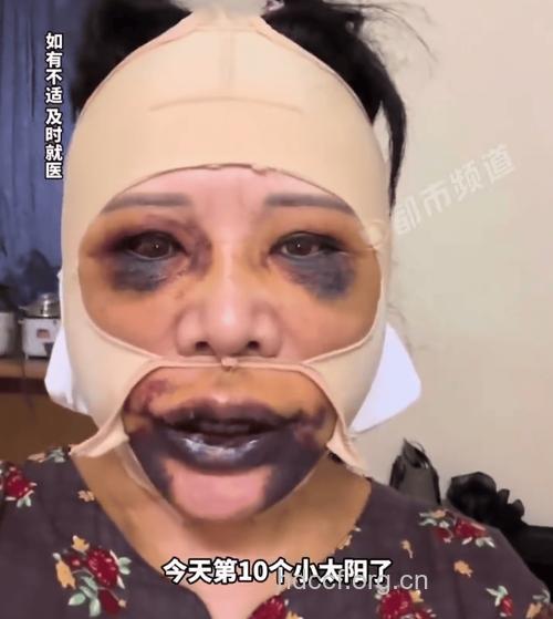 女子整形致眼肿嘴唇流血 吐词不清上街呼救