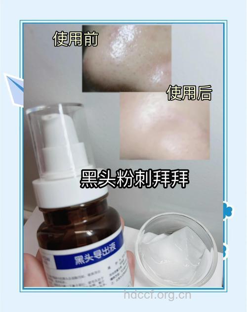 使用黑头导出液有哪些注意事项