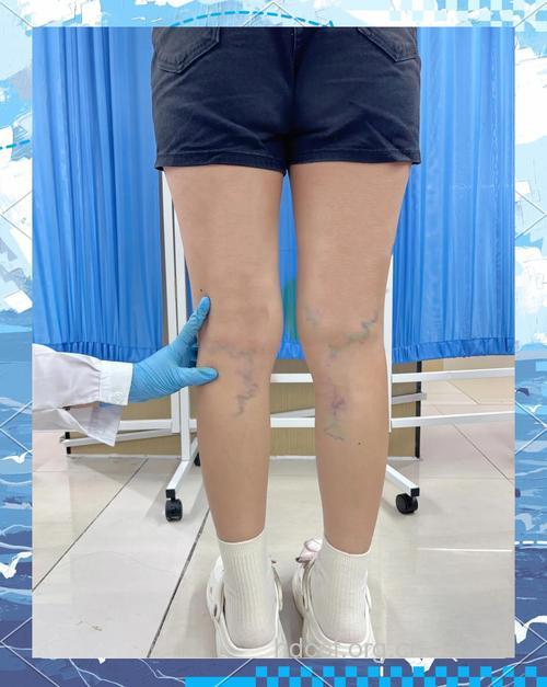 爱美女孩穿“静脉曲张袜”瘦腿勒出湿疹
