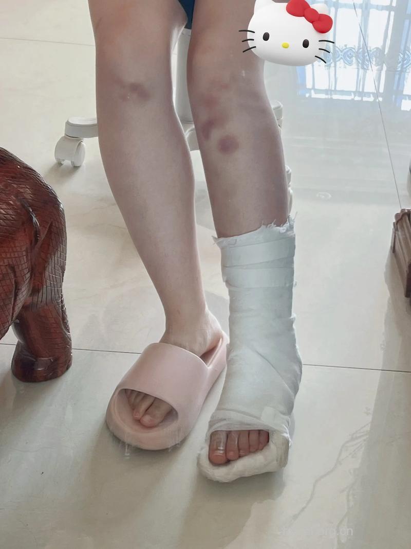 狂吃减肥药24岁女子患骨质疏松 崴脚后骨折
