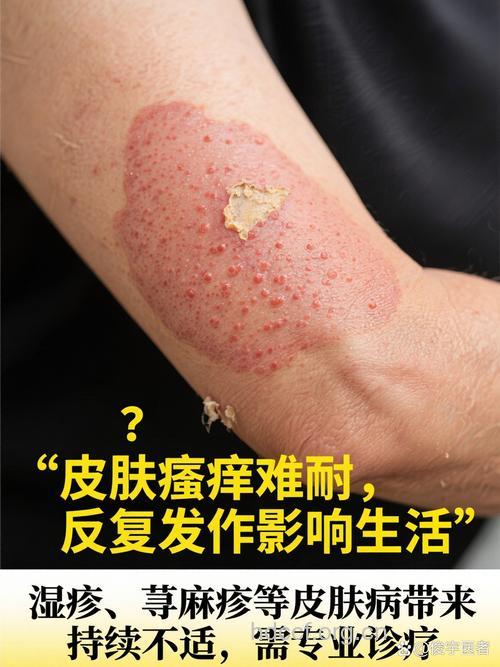 乱用减肥膏招来重度接触性皮炎