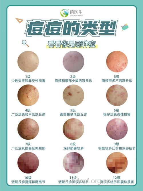 关于痘痘有哪些常见问题