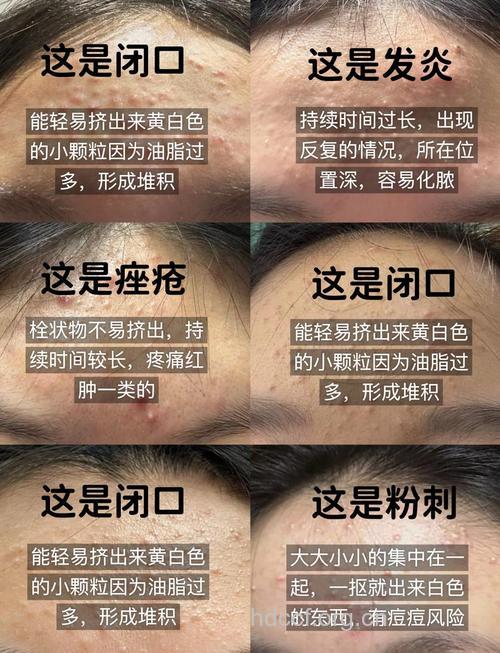 哪些方法可有效对付粉刺方法
