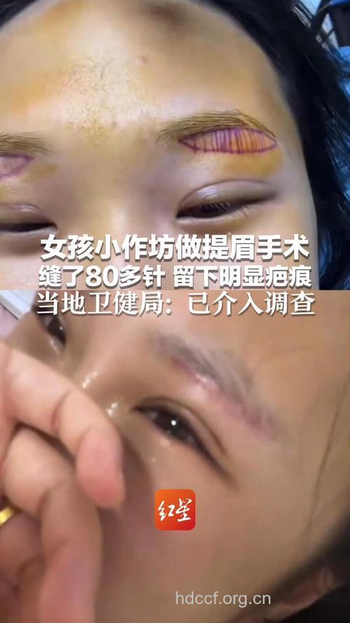 激光褪眉褪出两条疤 女子索赔15万元讨说法