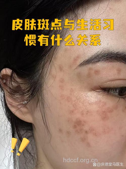 夏季不防晒 脸上就长斑