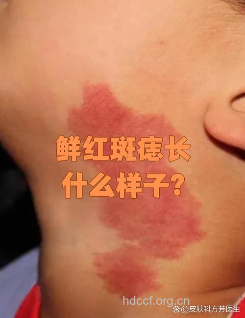 怎么祛除面部红色斑方法