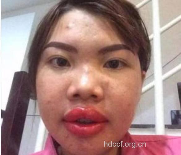 凤姐整形 称对男性粉丝负责