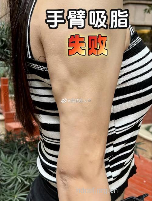 吸脂6次 换来皮肤坑坑洼洼