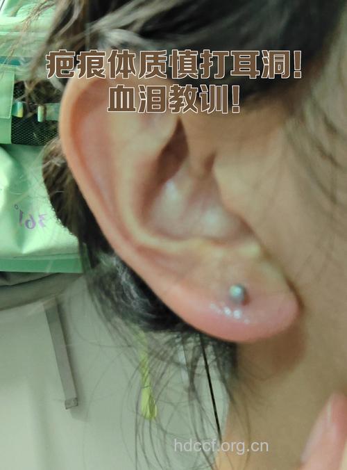 疤痕体质者不宜扎耳洞