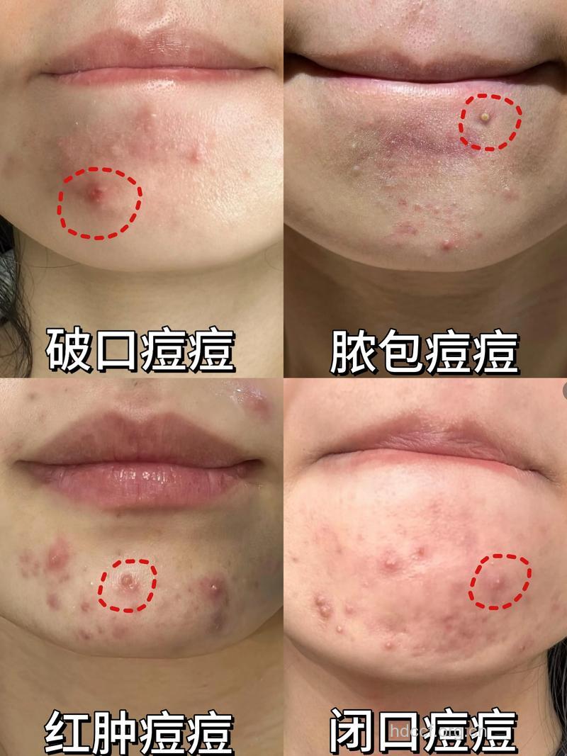 怎样去除下巴的痘痘