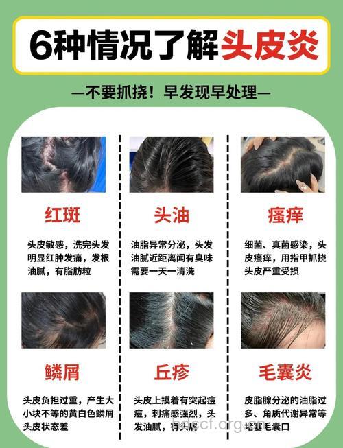 头皮痒不停？选对方法早护发