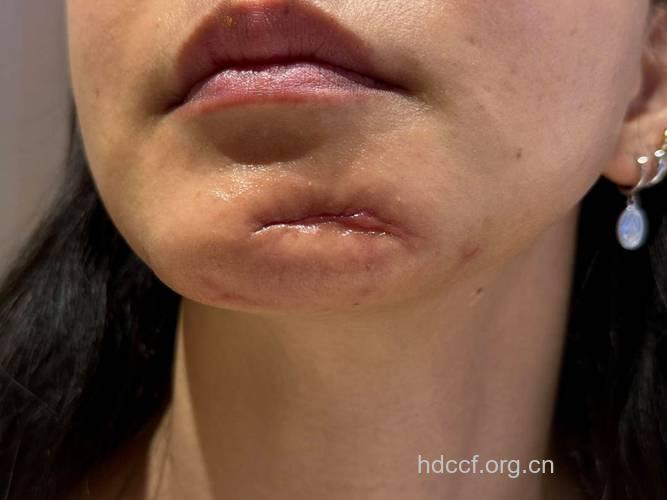 整形也DIY，美一女子遭毁容