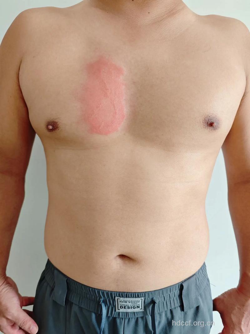 美一男子被蜂蛰后长丰满乳房