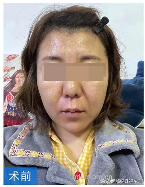 惊爆：扬州今夏整容手术量增三倍