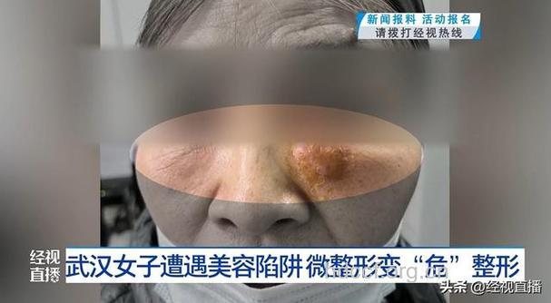 专家揭露若干整形美容陷阱