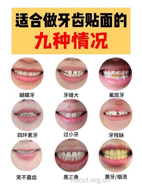治疗四环素牙可以保持多久呢?