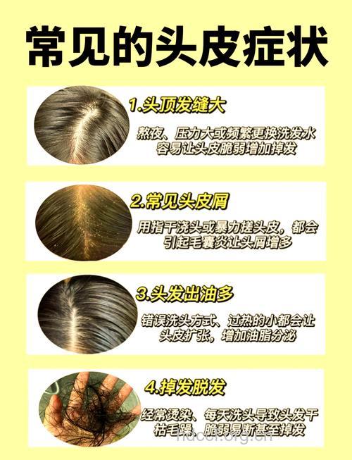 去除头皮屑有哪些常见的问题