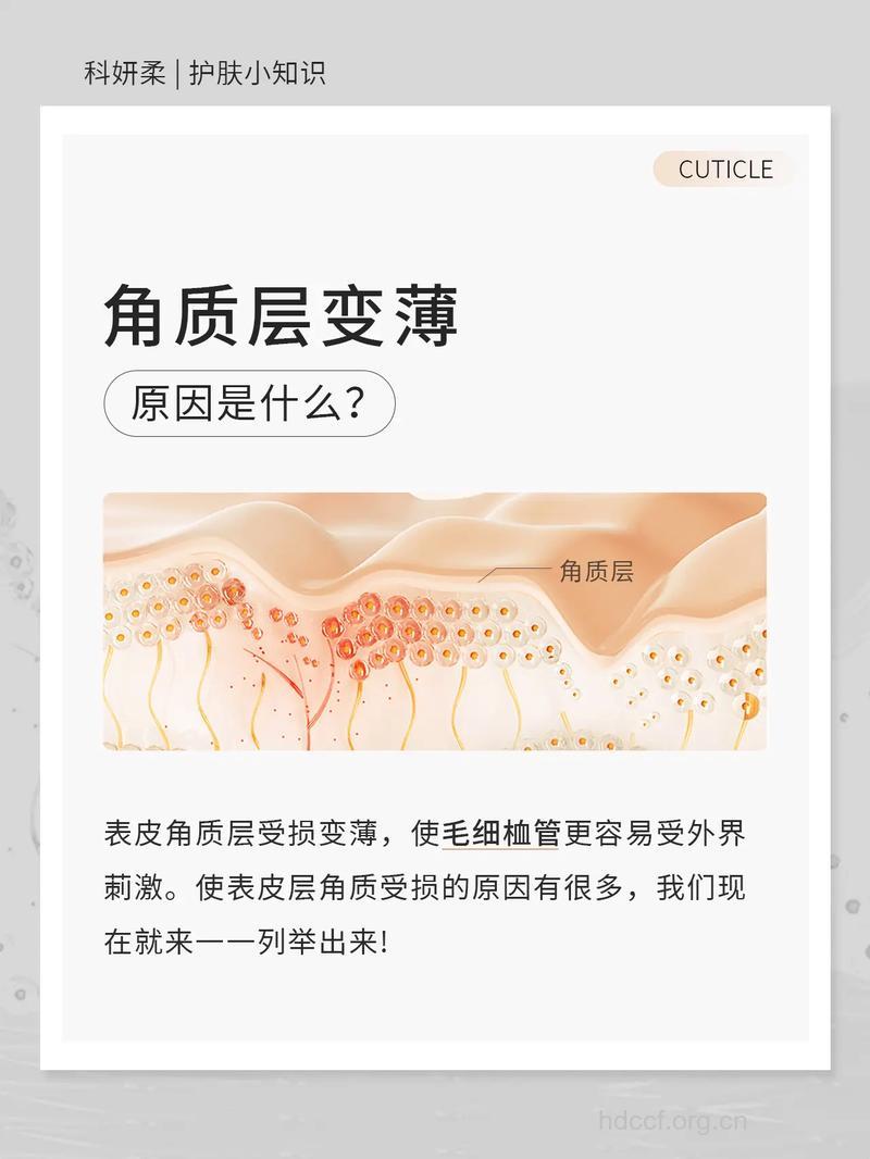 角质层太薄怎么办 5招提升肌肤免疫力