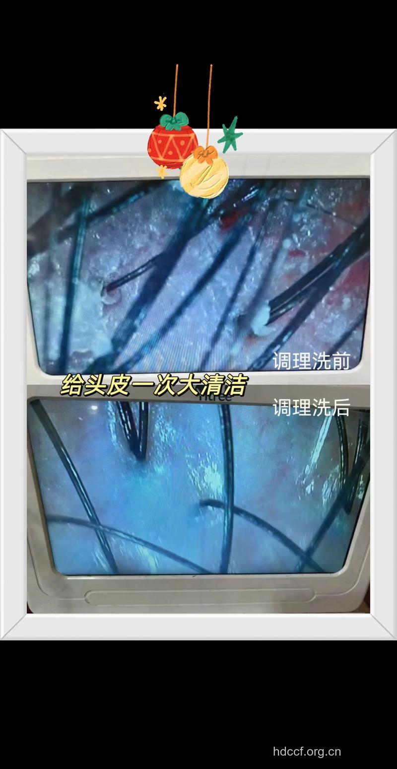 流动水冲洗头发可有效预防毛囊炎