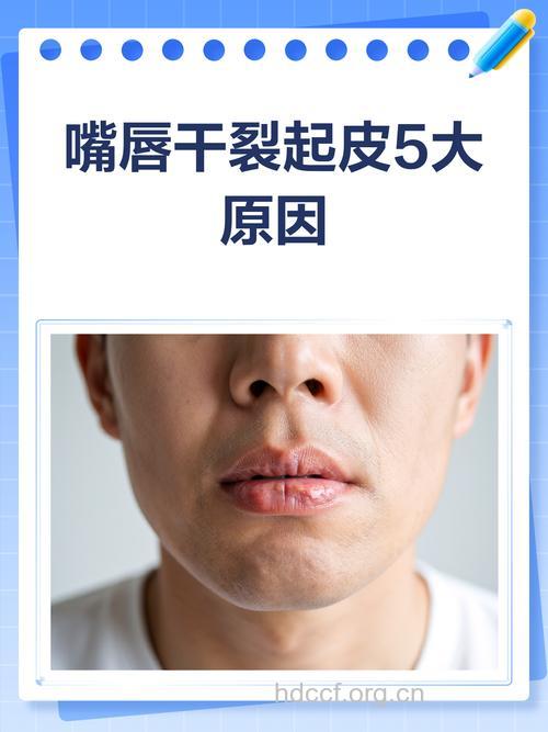 造成唇部干燥的3大幕后黑手