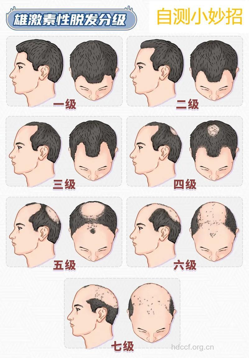 男性秃顶的4大生理优势