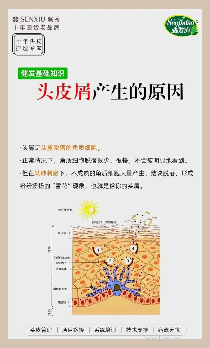 头皮屑产生的原因及治疗方法