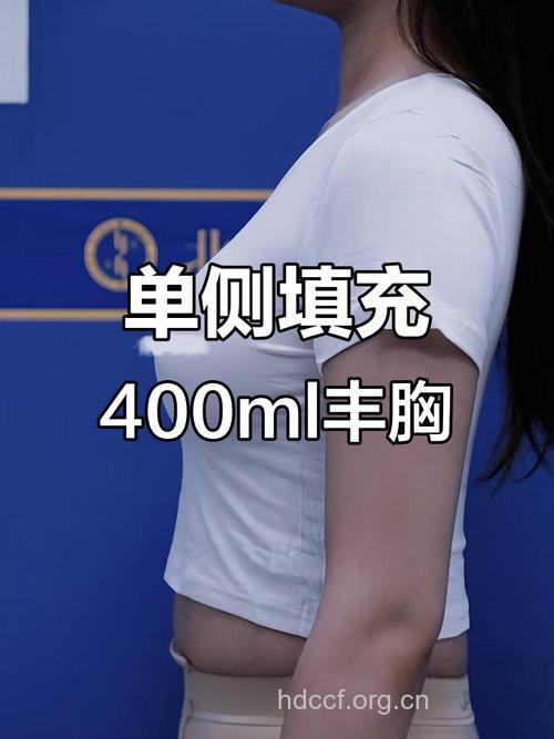 吸脂丰胸效果怎么样