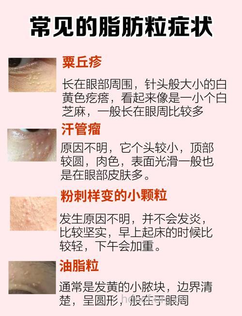 脂肪粒可真烦人 6招祛除这些脂肪粒