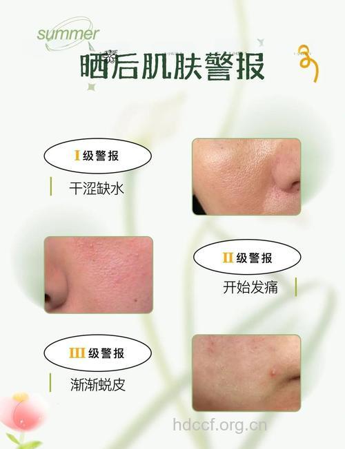 晒后细纹加深怎么办