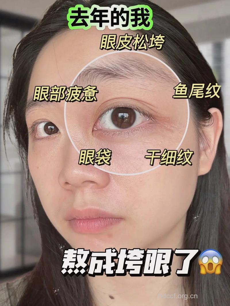 你容易长眼周干纹吗?教你3招对抗眼周干纹