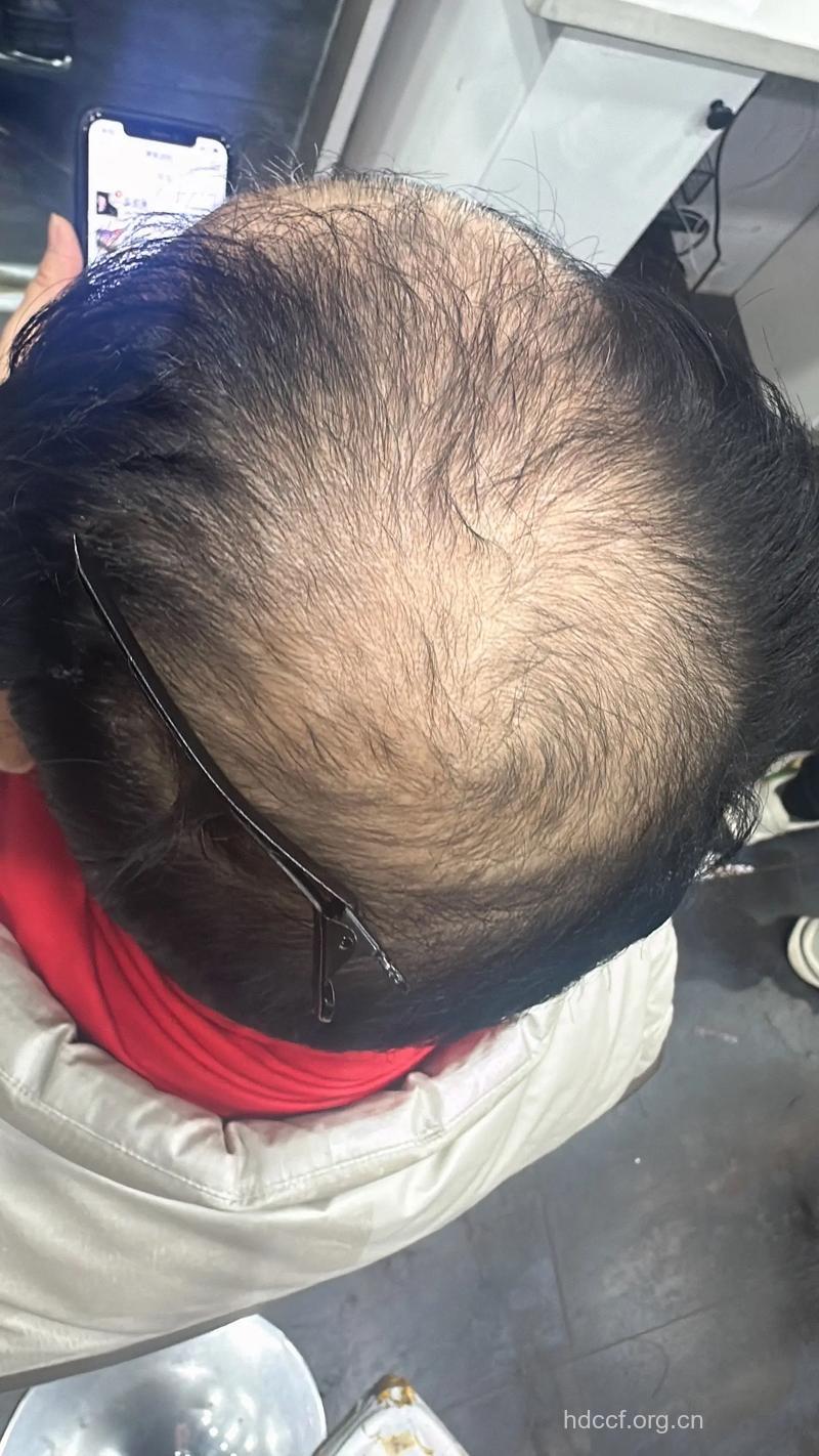 拯救男士“地中海”的尴尬