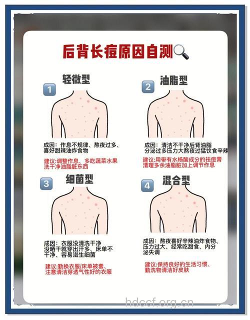 应对后背长痘痘的祛痘小诀窍