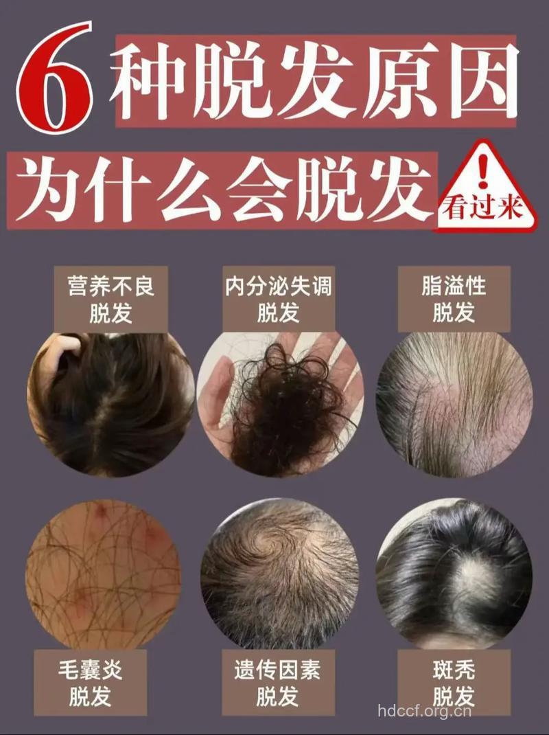 脱发断发头皮屑可能缺少的营养素