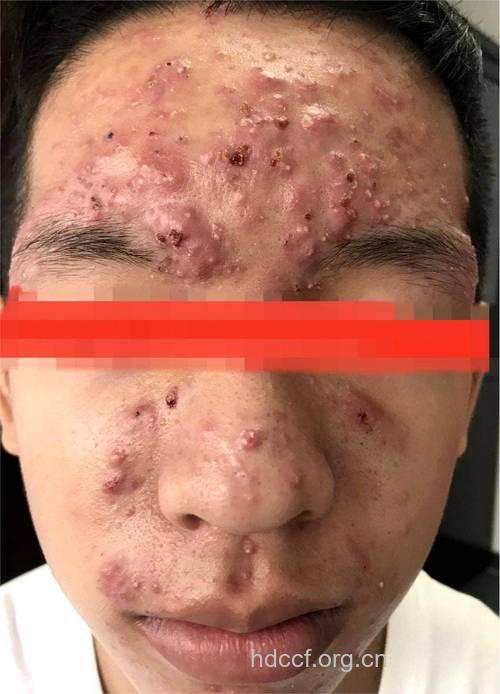 压力,可怕的恶化粉刺真凶