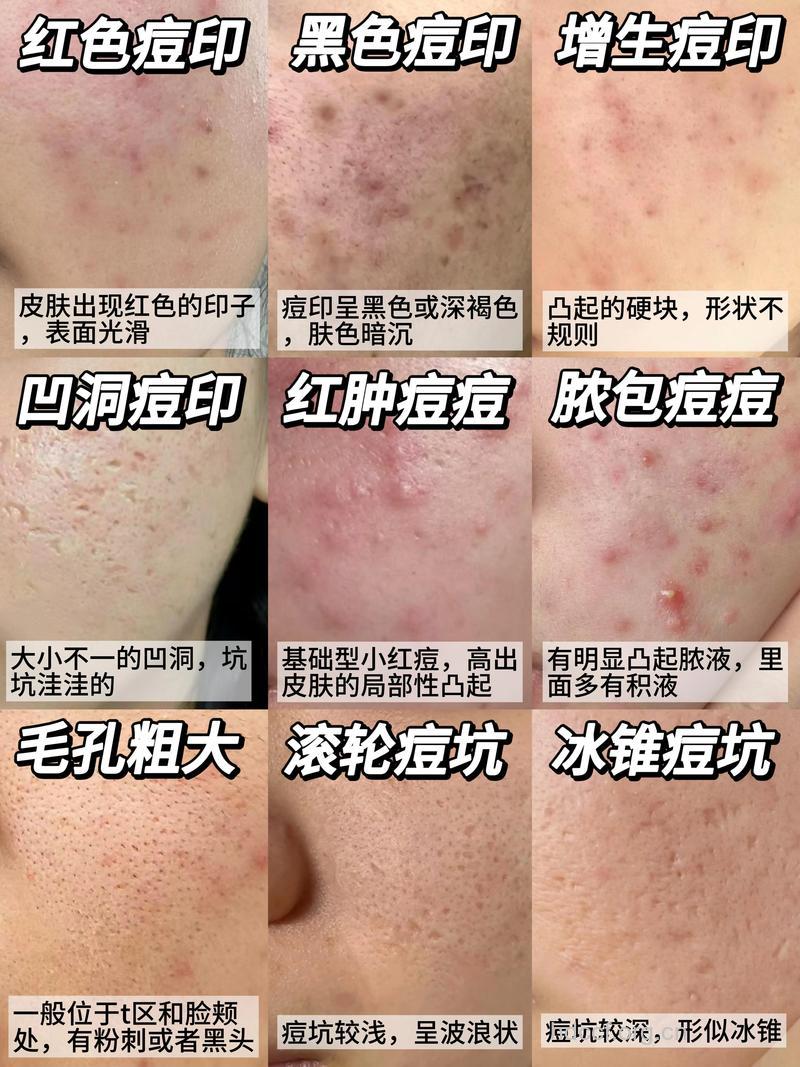 痘印好坑爹 如何避免痘印烦恼找上门