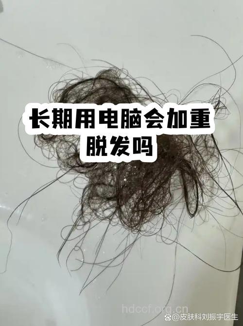 长期用电脑会造成脱发吗