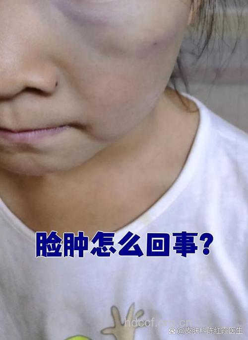 五分钟脸部水肿不再来