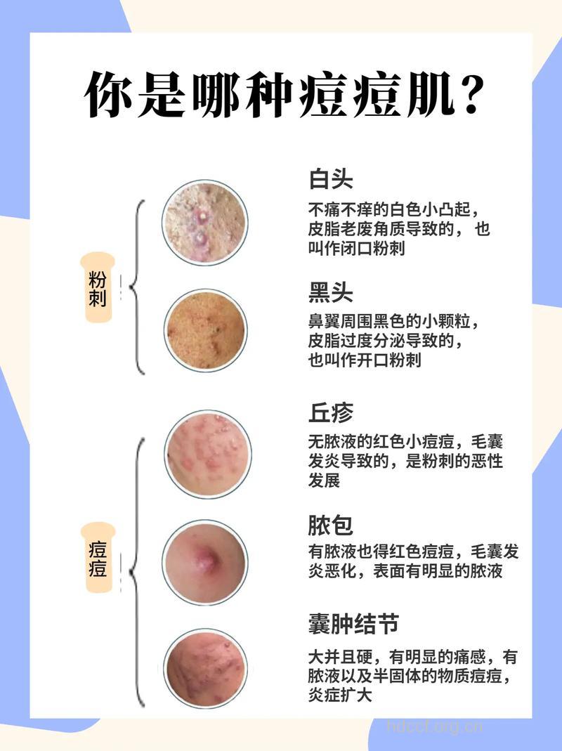 鼻子上长痘痘竟然是这些原因