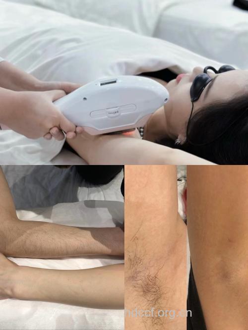 冰点激光脱毛技术怎么样