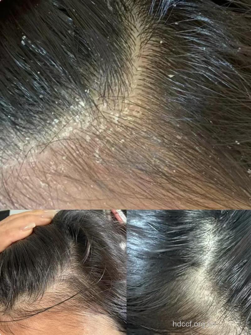 确定那是头皮屑吗