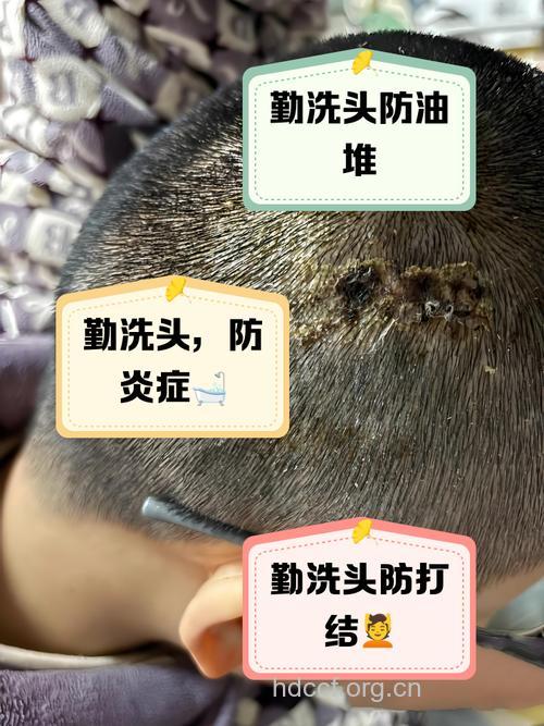 小S14天不洗头!医生直斥