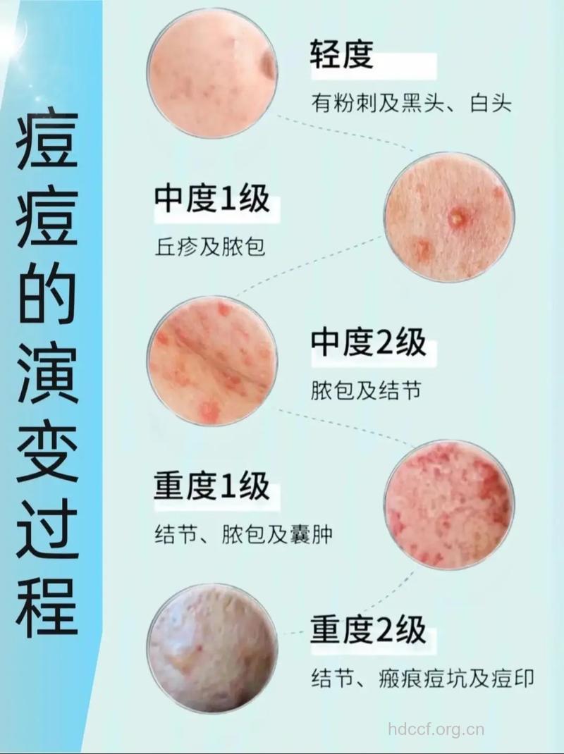 痘痘皮肤要去角质吗