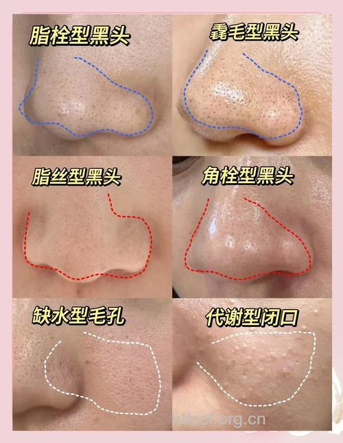 四招祛除黑头快速告别草莓鼻