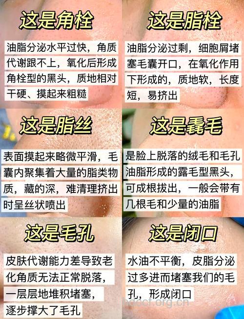 跳出黑头怪圈现象 正确去黑头