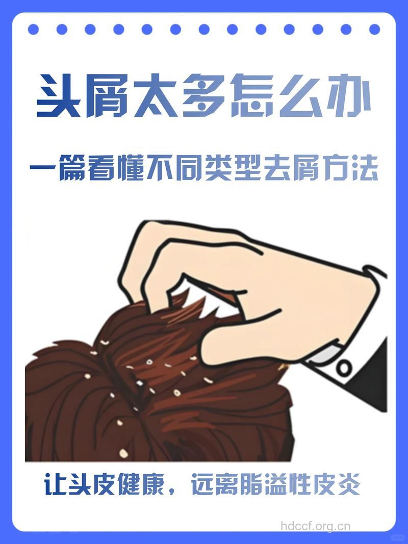 预防头屑过多的5种方法