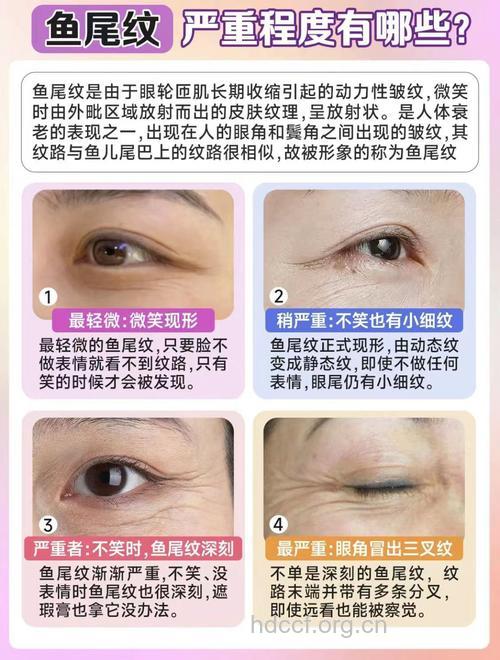 去除鱼尾纹 守护年龄秘密