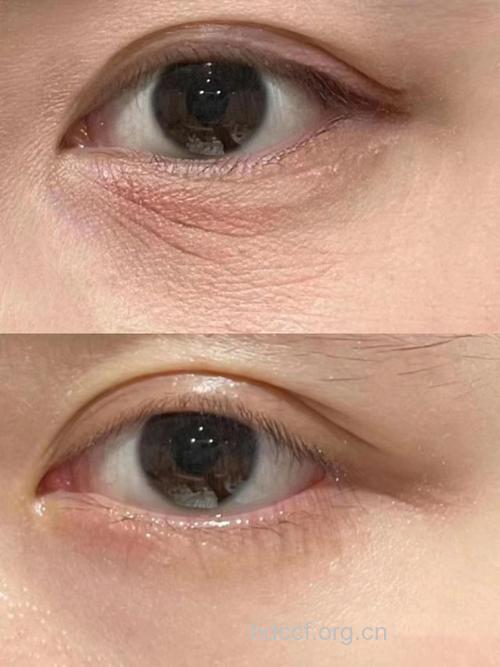 去除眼部皱纹 尽显迷人双眸