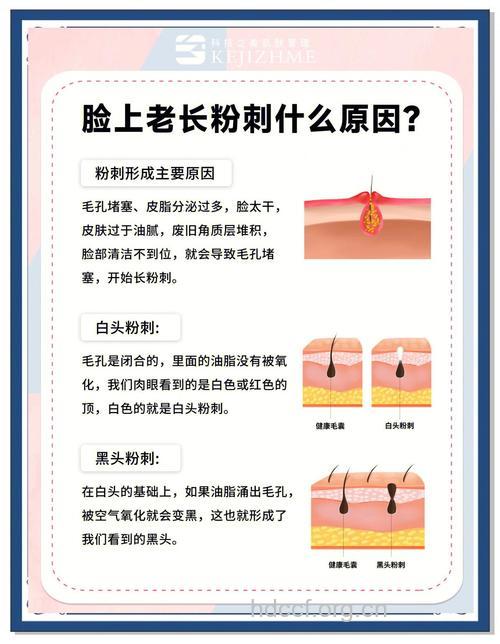 你知道脸上为什么会长粉刺吗