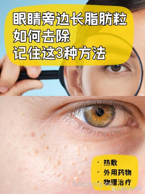 眼睛长脂肪粒怎么办