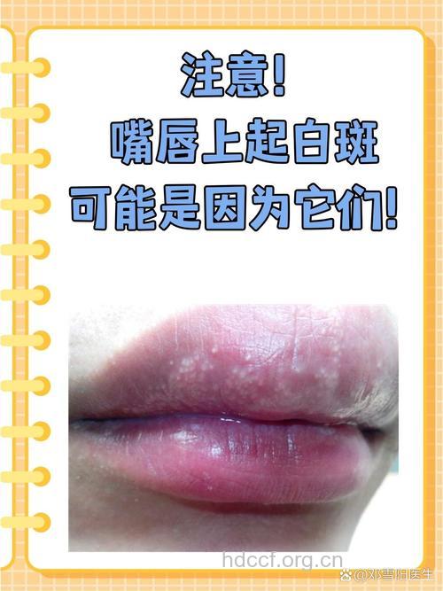 嘴唇长斑是何原因 唇部斑点不容忽视